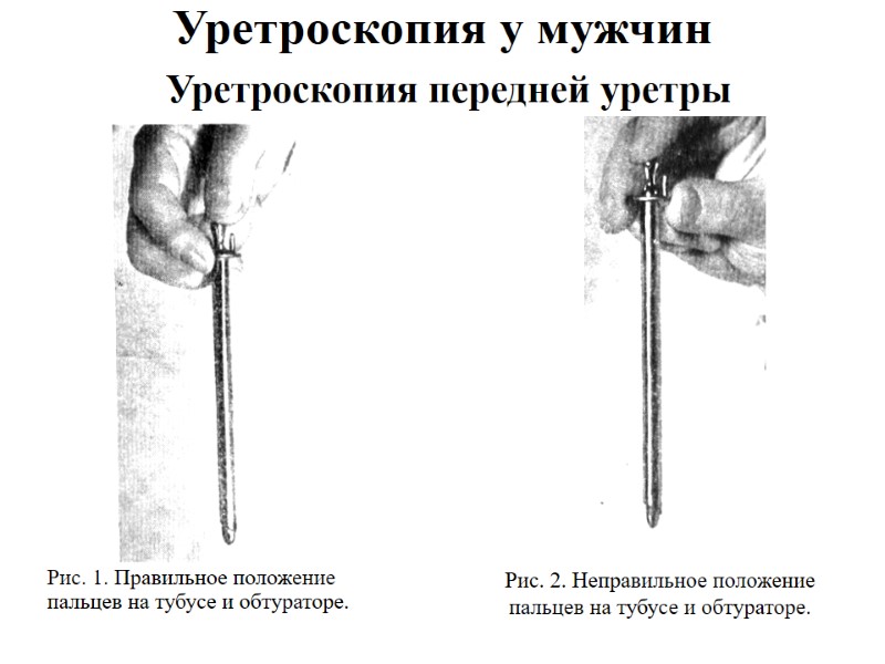 Уретроскопия у мужчин  Уретроскопия передней уретры Рис. 2. Неправильное положение пальцев на тубусе